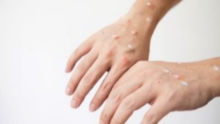 dinkes-meranti-pastikan-tidak-ada-penambahan-kasus-suspek-cacar-monyet